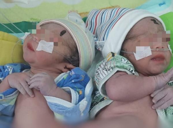 RSUD dr Iskak Terima Rujukan Bayi Kembar Siam