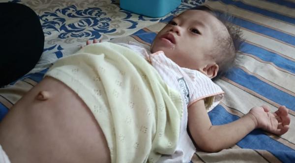 Bayi Yatim di Sumur Alami Pembengkakan Perut sejak Lahir, Butuh Pertolongan