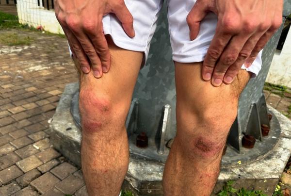 Usai Gagal Selebrasi Knee Slide di Lapangan SUGBK, Ini Penampakan Lutut Thom Haye yang Terluka