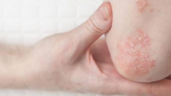 Cegah Dermatitis Atopik Penyakit Kulit dengan Cara ini