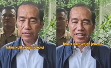 Presiden Ke 7 Joko Widodo Diduga Terkena Sindrom Stevens Johnson: Penyakit Kulit Langka 