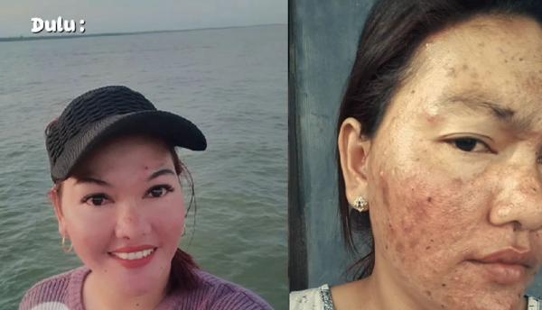 Viral! Wajah Wanita Ini Putih Mulus 10 Tahun Pakai Skincare Abal-abal, Endingnya Bikin Pilu