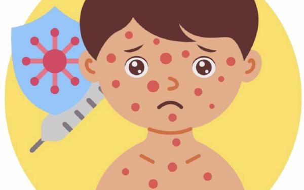 Lima Kasus Campak Ditemukan di Bojonegoro, Balita Paling Rentan