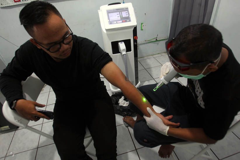 Melihat Proses Menghilangkan Tato di Badan - Bagian 11