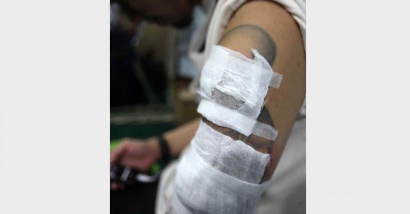 Melihat Proses Menghilangkan Tato di Badan - Bagian 9