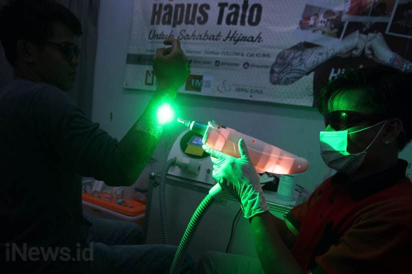 Melihat Proses Menghilangkan Tato di Badan - Bagian 7