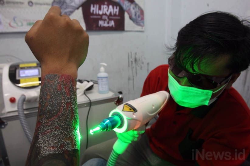 Melihat Proses Menghilangkan Tato di Badan - Bagian 6