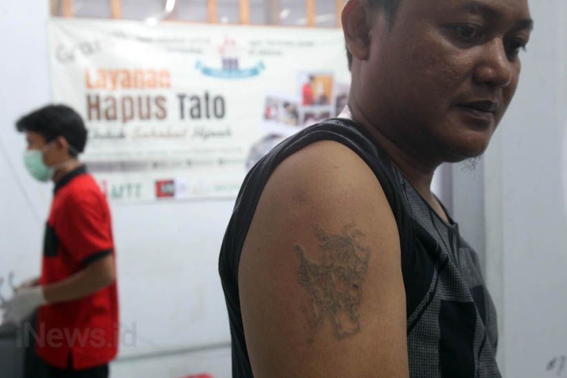Melihat Proses Menghilangkan Tato di Badan - Bagian 14
