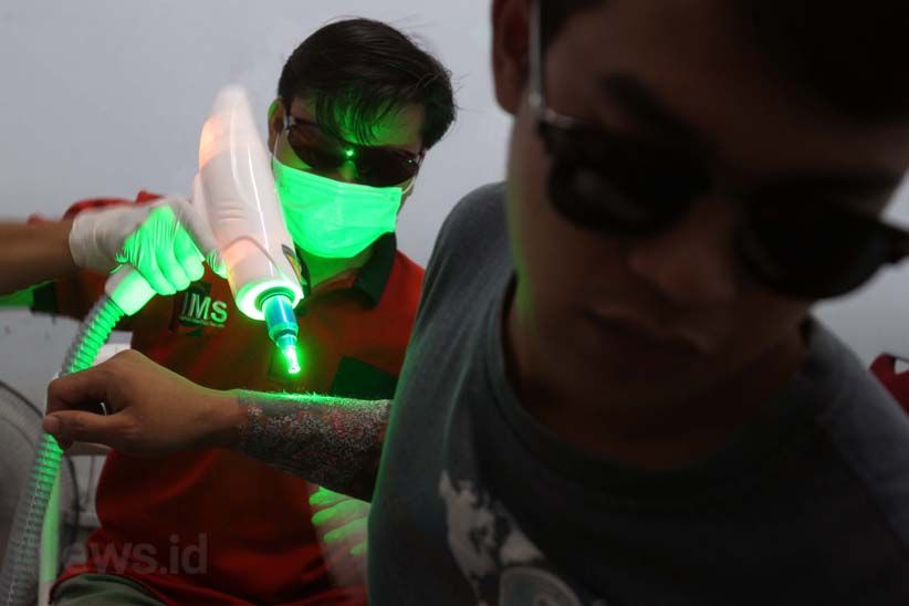Melihat Proses Menghilangkan Tato di Badan - Bagian 5