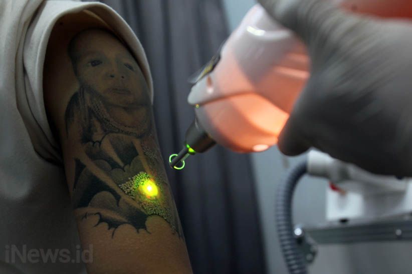 Melihat Proses Menghilangkan Tato di Badan - Bagian 4