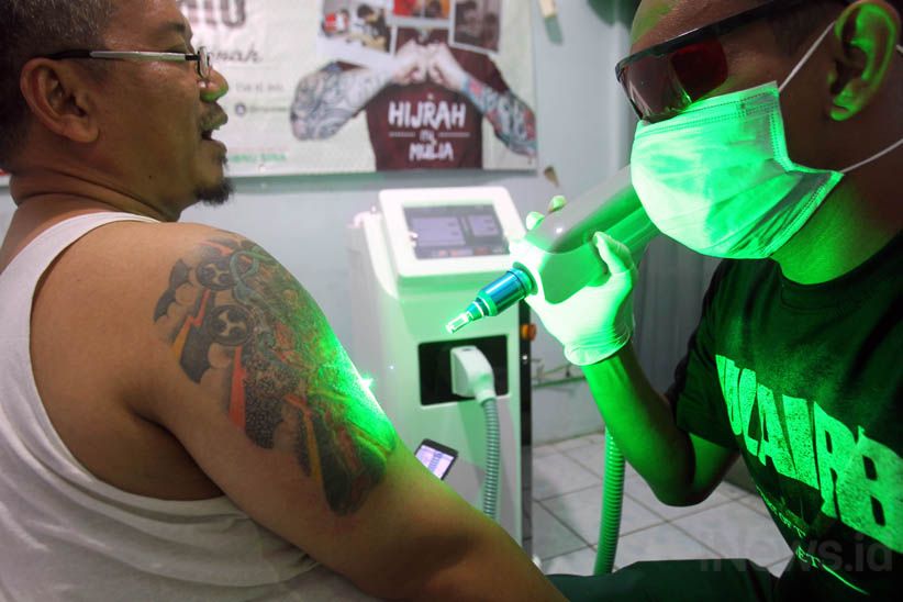 Melihat Proses Menghilangkan Tato di Badan - Bagian 3