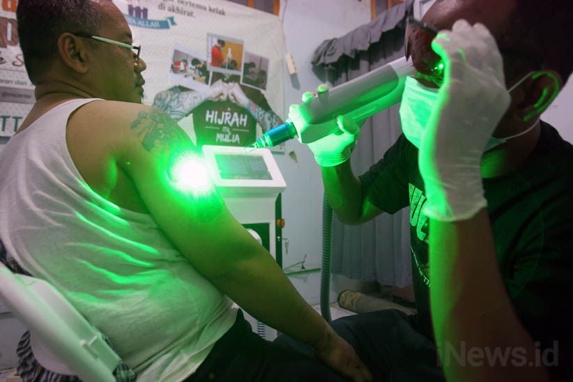 Melihat Proses Menghilangkan Tato di Badan - Bagian 2