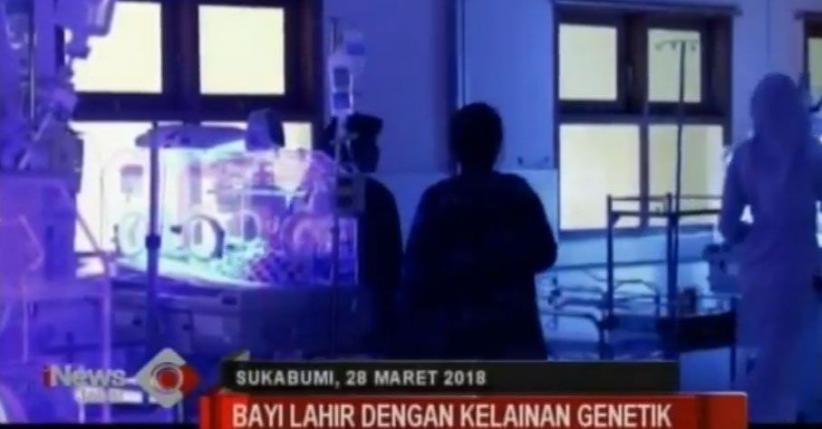Alami Kelainan Genetik, Bayi di Sukabumi Ini Tak Punya Otot Perut