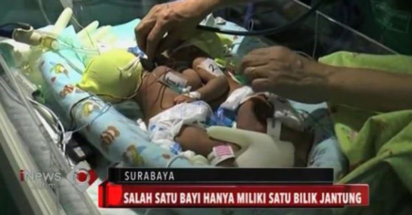 Bayi Kembar Siam Asal Lamongan Didiagnosis Punya Kelainan Jantung