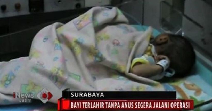 Perut Terus Membesar, Bayi Tanpa Anus Dirawat Intensif