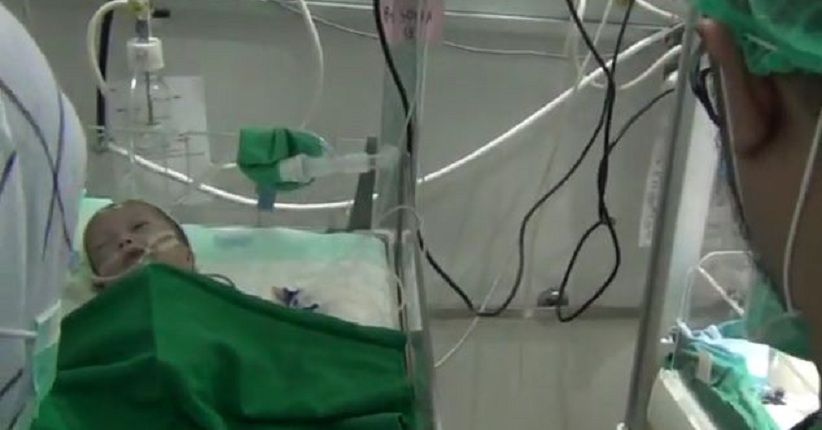 Bayi Kembar Siam Dempet Perut Sofia dan Salma Sukses Operasi Pemisahan