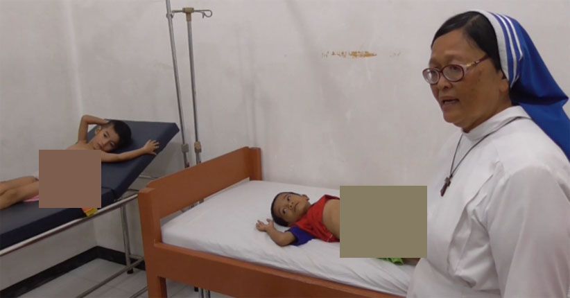 2 Balita Miskin di Nias Ini Tidak Miliki Anus dan Derita Gizi Buruk