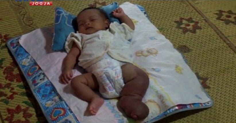Bayi Perempuan Asal Gunungkidul Ini Diduga Kena Penyakit Kaki Gajah