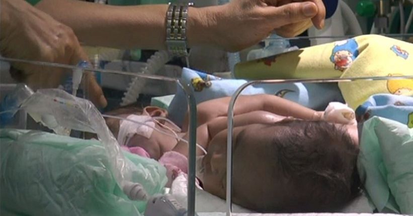 Kritis, Bayi Kembar Siam Dempet Dada Perut Asal Ternate Akan Dioperasi