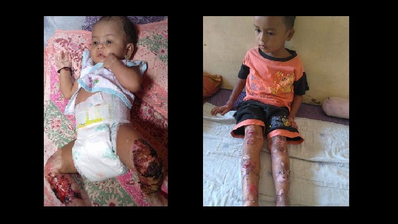 2 Bocah di Madina Terkena Toksoplasma, Kulitnya Melepuh dan Terkelupas