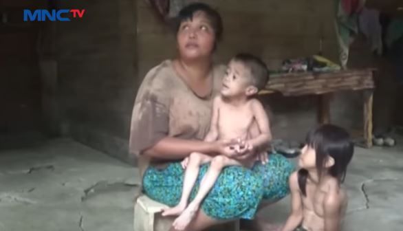 Sejak Pandemi, Kasus Balita Gizi Buruk di Bandung Meningkat 