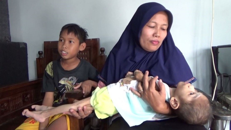 Menderita Penyakit Aneh, Balita 4 Tahun Bertubuh Kaku seperti Kayu