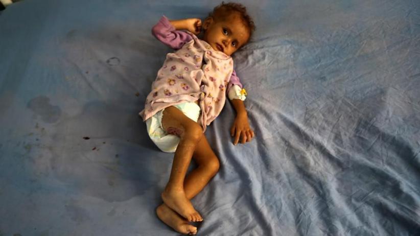 Kasus Malnutrisi Masih Ditemukan di Kaltim, Mayoritas Usia Balita