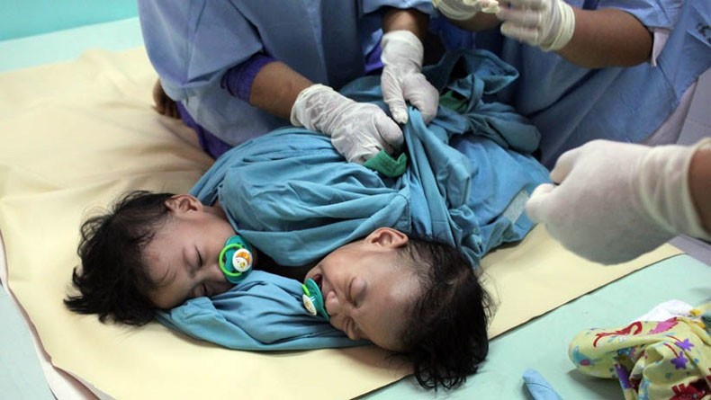 Dioperasi 5 Jam, Akila dan Azila Berhasil Dipisahkan Tim Dokter RSU dr Soetomo