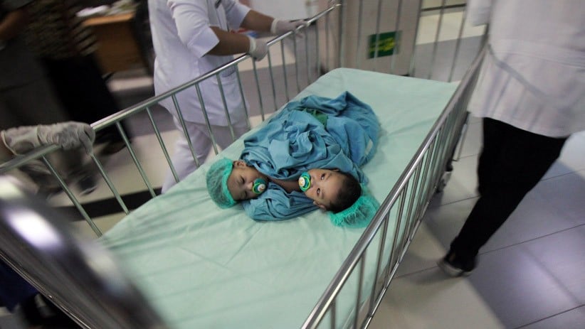 Kembar Siam Aqila dan Azila Jalani Operasi Pemisahan - Bagian 3