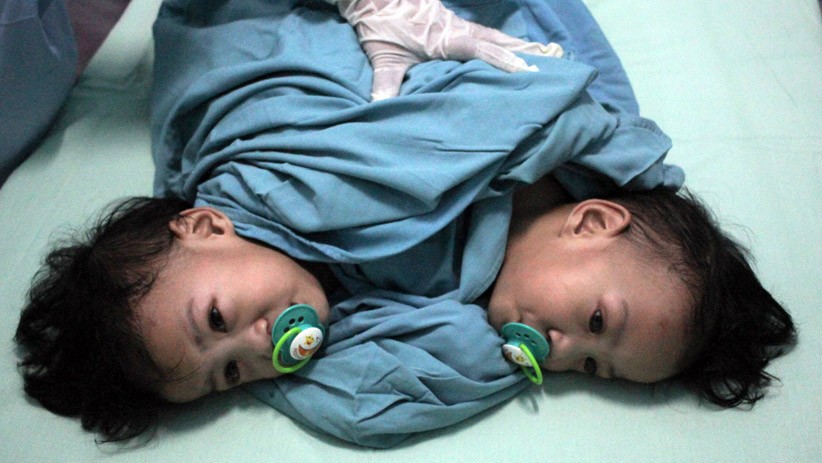 Kembar Siam Aqila dan Azila Jalani Operasi Pemisahan - Bagian 2
