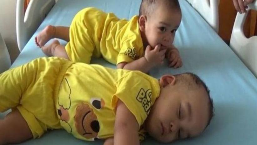 Bayi Kembar Siam Dempet Perut Adam dan Malik Membaik usai Operasi Pemisahan