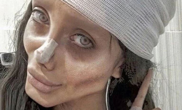 Operasi Plastik Demi Mirip Angelina Jolie Selebgram Iran Malah Ditangkap