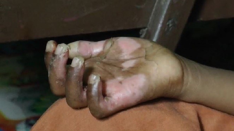 Kejam, Tangan Anak Dibakar Ibu Tiri Hingga Melepuh dan Cacat Permanen