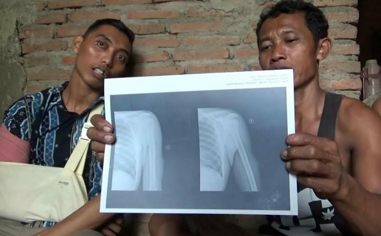 Driver Ojol Korban Klitih di Sleman Berharap BPJS Bisa Tanggung Pengobatan