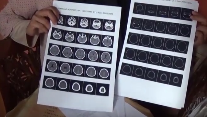 Diduga Dipukul Kakak Kelas, Siswa SMP di Bangka Dirawat di Rumah Sakit