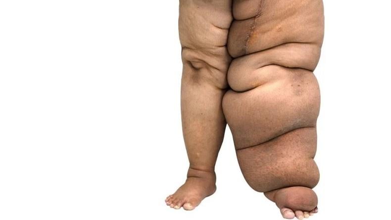 1 Kasus Kaki Gajah Ditemukan di Pulau Morotai dalam 4 Tahun Terakhir