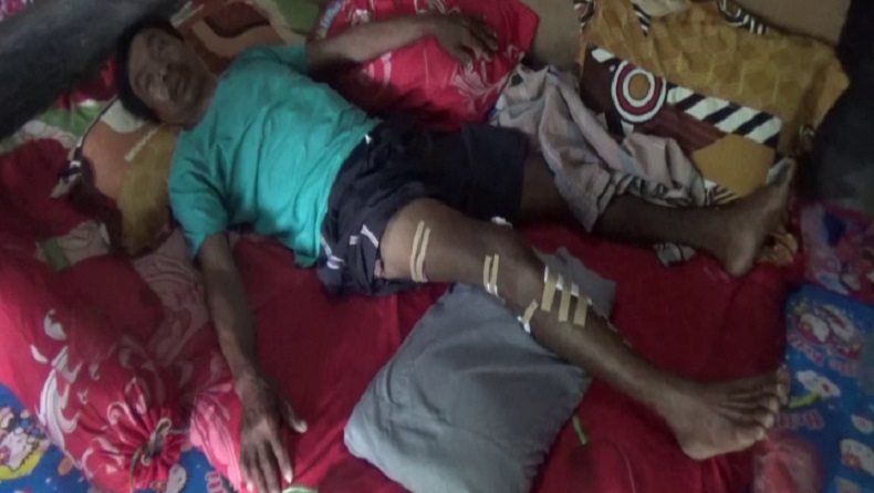 Ngeri, Nelayan Diterkam Buaya saat Cari Udang hingga Mendapat 37 Jahitan