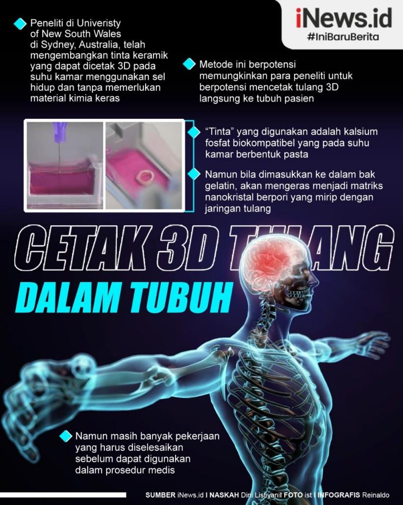Infografis Cetak Tulang 3D di Dalam Tubuh