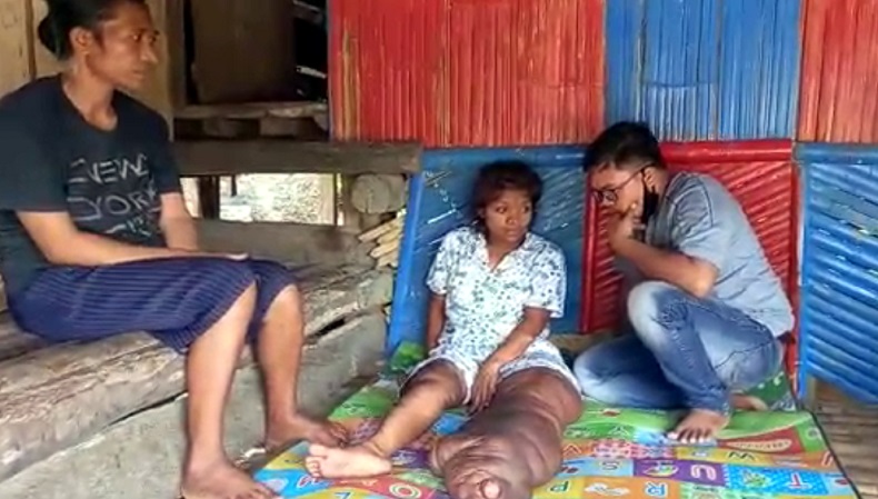 Tolong, Gadis Penderita Kaki Gajah di Sumba Barat Daya Ini Butuh Uluran Tangan