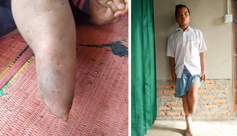 Tolong, Pelajar SD di Pasaman Barat Butuh Kaki Palsu Baru