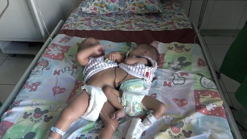 Ini Bayi Kembar Siam yang Sukses Dioperasi di RSUD Dr Moewardi Solo  