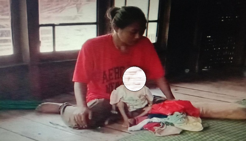 Pengobatan Tak Tuntas, Balita di Cianjur  Selatan Idap Gizi Buruk 