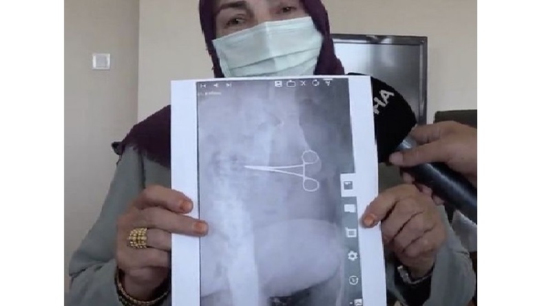 Waduh, Seusai Operasi, Gunting Bedah Tertinggal di Perut Nenek Ini