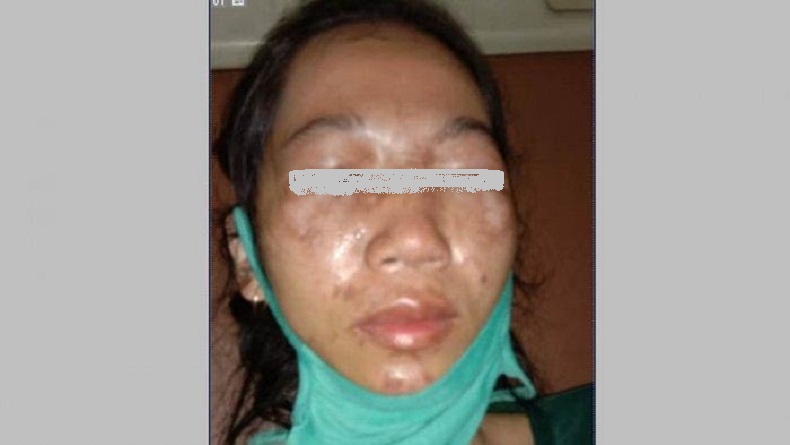 Guru TK Cantik di OKU Timur Disiram Cuka Para, Wajah Rusak dan Mata Buta