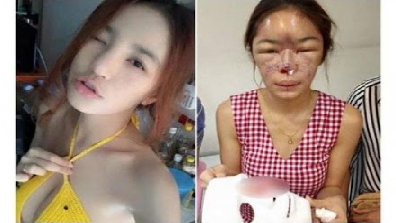 Sedih Amat, Gegara Semakin Jelek Seusai Operasi Plastik, Perempuan Ini Dicerai Suami