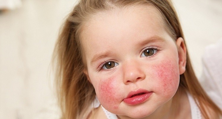 Jangan Anggap Remeh Alergi Kulit pada Anak, Begini Cara Mengatasinya 