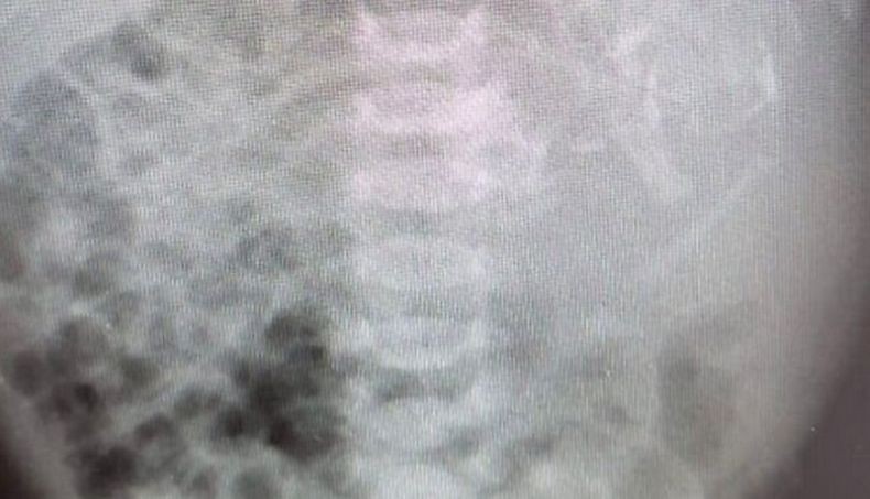 Baru Dilahirkan, Bayi Ini Punya Janin Kembar di Perutnya