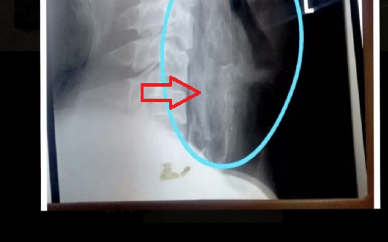 Ngilu, Ikan Papuyu Hidup Tersangkut di Tenggorokan Pemancing Balangan