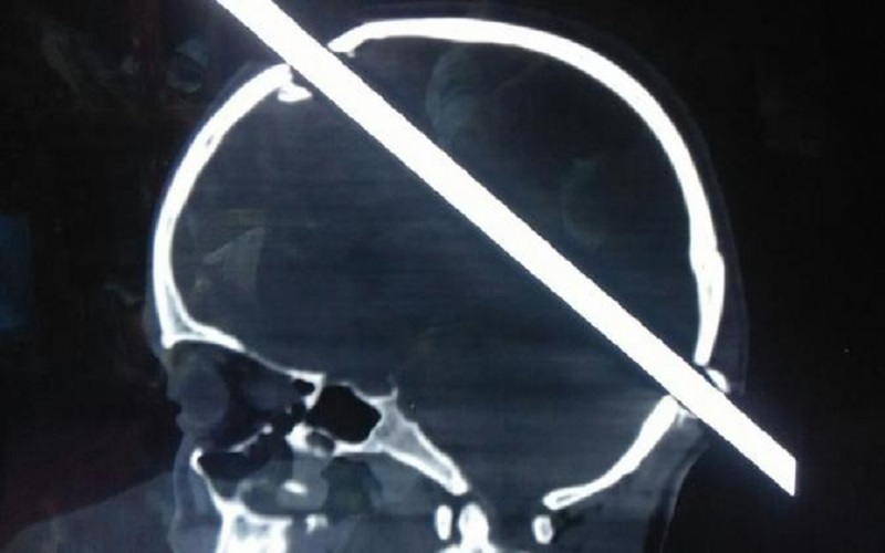 Ubun-ubun Kepala Tertembus Besi 6 Meter, Pria Ini Selamat, Kok Bisa?