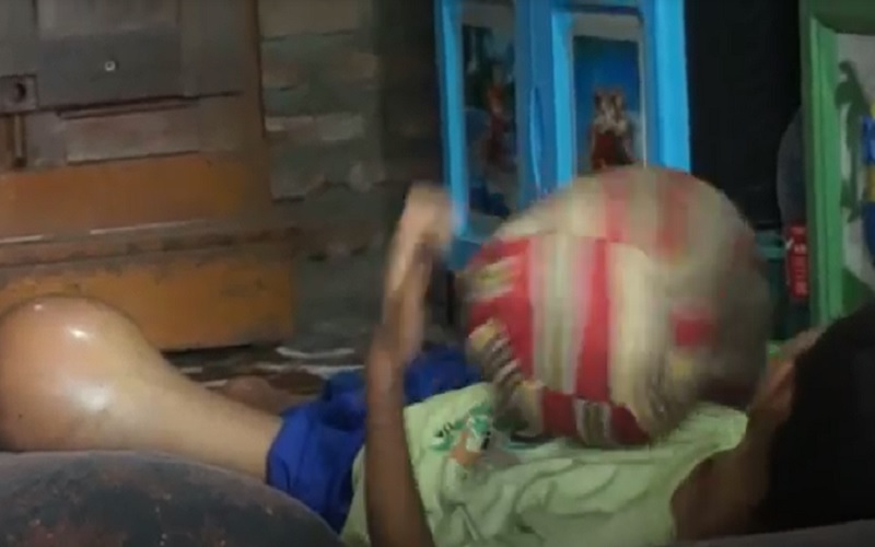 Berawal dari Jatuh, Kaki Bocah Ini Bengkak Sebesar Melon hingga Harus Diamputasi